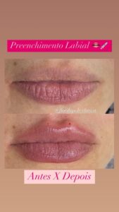 clinica-florpele-campinas-antes-depois-11.jpeg